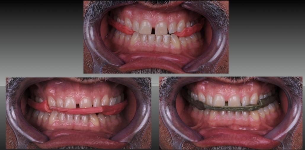 Arco facciale e articolatore analogici