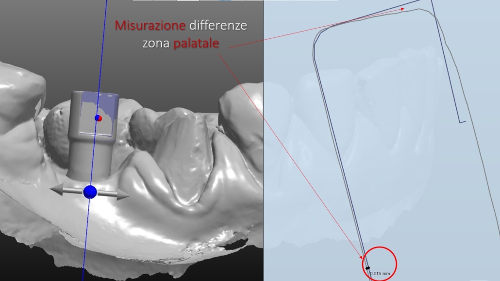 Scanbody ed impronte digitali - Affidabilità nella routine