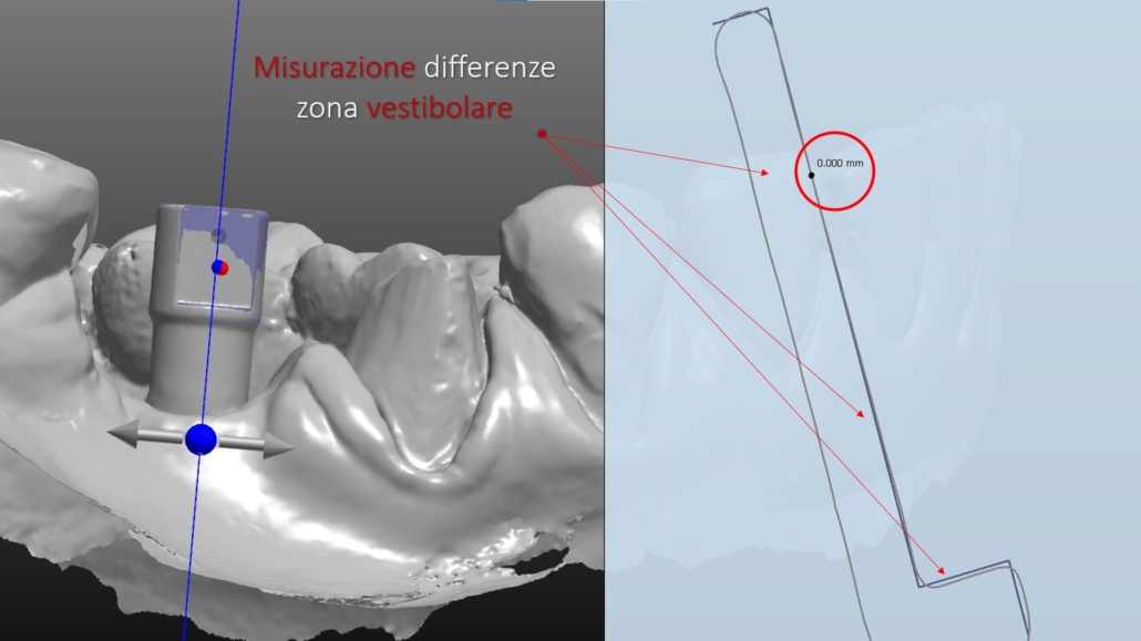 Scanbody ed impronte digitali - Affidabilità nella routine