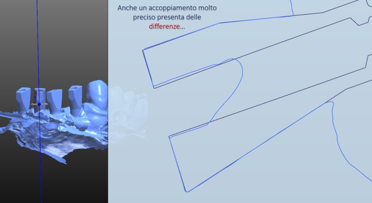 Scanbody ed impronte digitali - Affidabilità nella routine