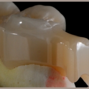 Attacchi individuali digitali Attacchi individuali digitali