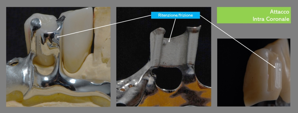 Attacchi individuali digitali