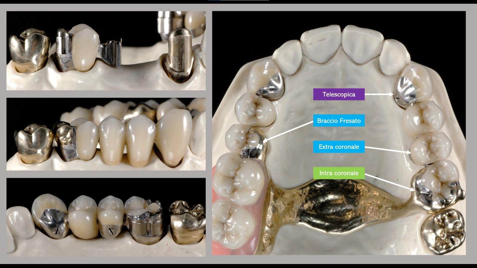 Kit Attacco Dentale Loc-In: 1 Protesi + 4 Cappucci Analogici - Compatibile Zimmer, MIS, Alpha Bio
